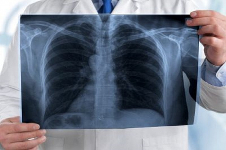 В 2020 году в Хабаровске был установлен печальный рекорд по заболеваемости внебольничной пневмонией фото 2